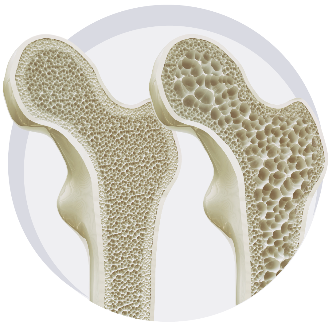 Knochenstruktur Knochenstruktur im Vergleich gesund vs Osteoporose